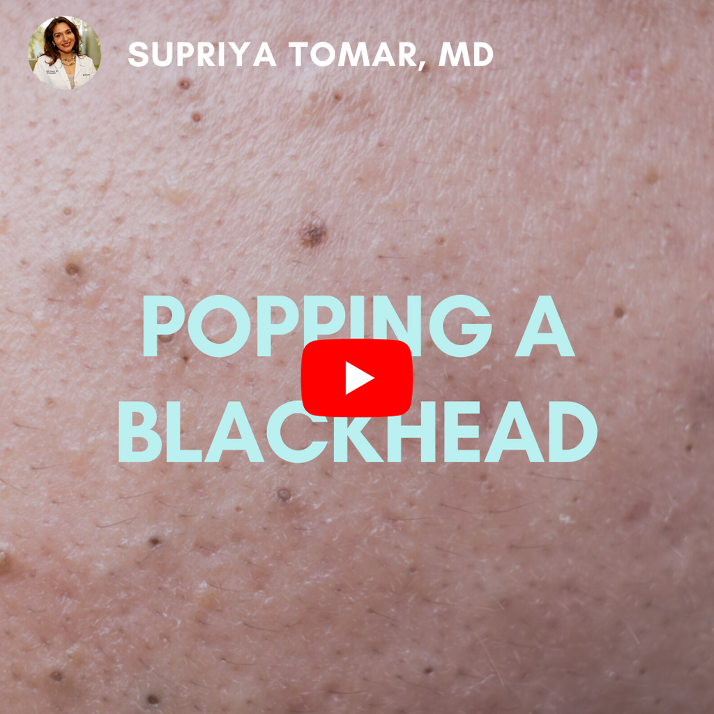 Blackhead Extractions | SupriyaMD Skincare Pimple Popping Satisfying Videos