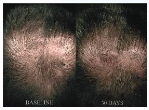 Hair Regrowth System