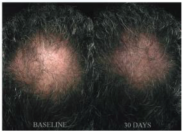 Hair Regrowth System