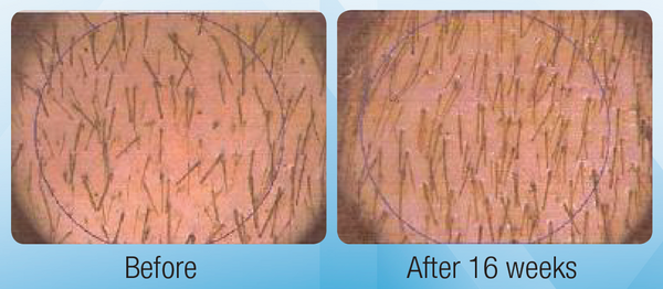 Hair Regrowth System