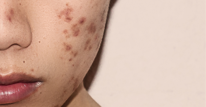 An acne face map? Here's what your acne-prone areas mean.