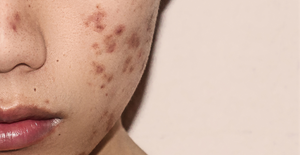 An acne face map? Here's what your acne-prone areas mean.