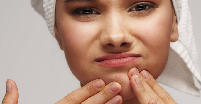 How To Cover Your Acne Without Making It Worse