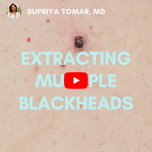Blackhead Extractions | SupriyaMD Skincare Pimple Popping Satisfying Videos